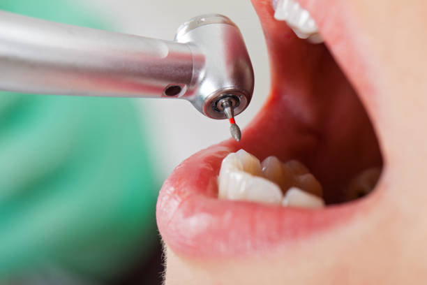 Best Emergency Dentist for Knocked-Out Tooth in Paulina, LA